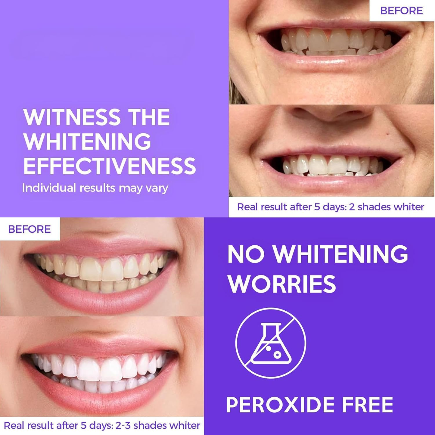 Before and after teeth bleach whitening results showing up to 3 shades whiter teeth peroxide free